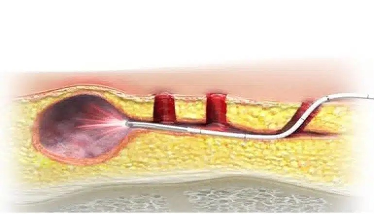 Kyste pilonidal laser